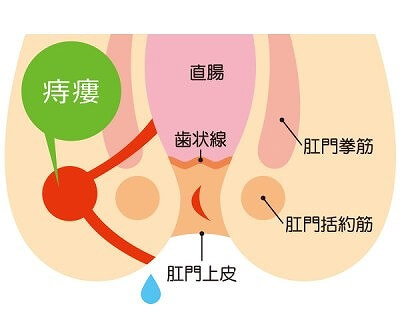 痔ろう(あな痔)