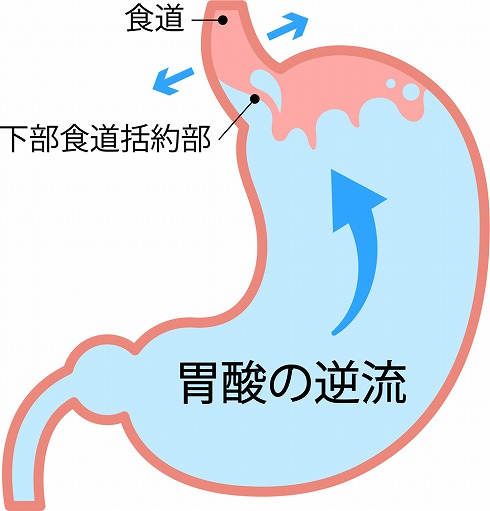 逆流性食道炎